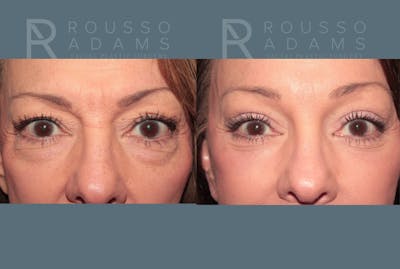 Blepharoplasty<span class=small>By Dr. Austin Adams</span> Before & After Gallery - Patient 147100 - Image 1