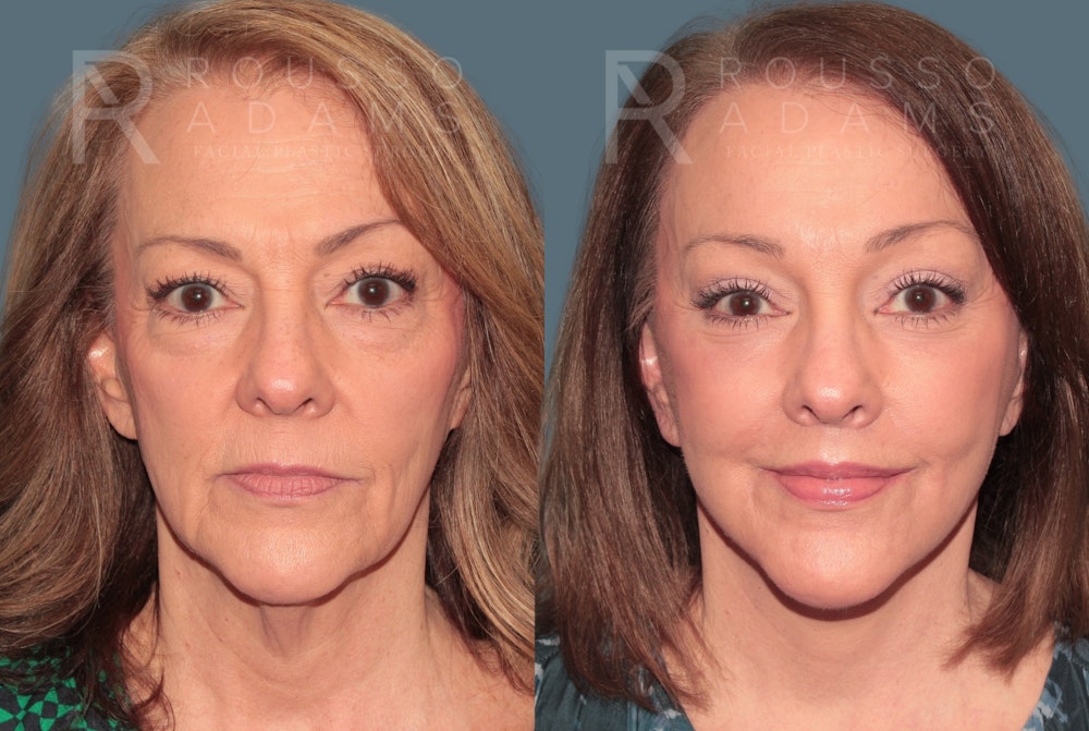 Deep Plane Facelift <span class=small>By Dr. Austin Adams</span> Before & After Gallery - Patient 422177 - Image 2