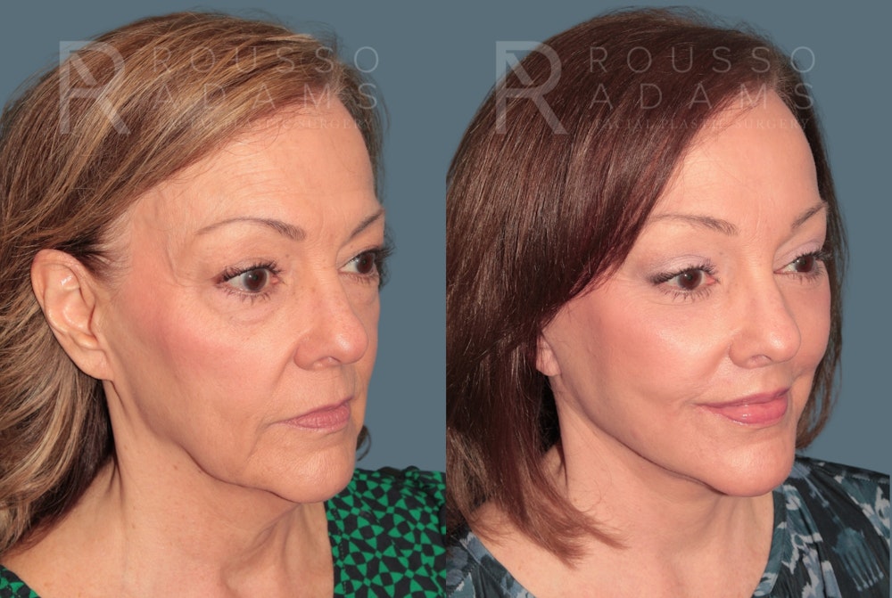 Deep Plane Facelift <span class=small>By Dr. Austin Adams</span> Before & After Gallery - Patient 422177 - Image 1