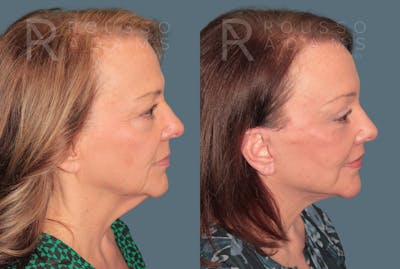 Blepharoplasty<span class=small>By Dr. Austin Adams</span> Before & After Gallery - Patient 147100 - Image 4