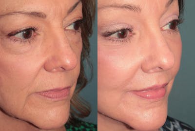 Deep Plane Facelift <span class=small>By Dr. Austin Adams</span> Before & After Gallery - Patient 422177 - Image 4