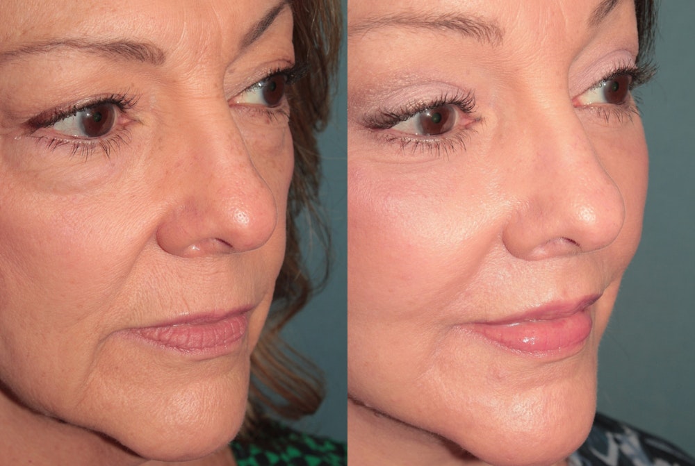 Deep Plane Facelift <span class=small>By Dr. Austin Adams</span> Before & After Gallery - Patient 422177 - Image 4