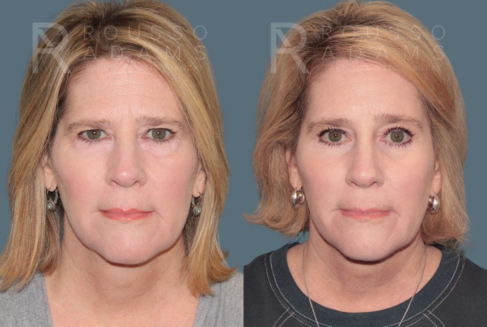 Blepharoplasty<span class=small>By Dr. Austin Adams</span> Before & After Gallery - Patient 364965 - Image 5