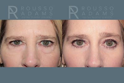 Blepharoplasty<span class=small>By Dr. Austin Adams</span> Before & After Gallery - Patient 364965 - Image 1