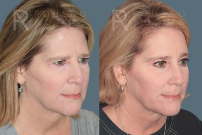 Blepharoplasty<span class=small>By Dr. Austin Adams</span> Before & After Gallery - Patient 364965 - Image 4
