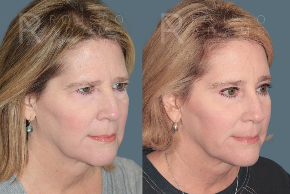 Blepharoplasty<span class=small>By Dr. Austin Adams</span> Before & After Gallery - Patient 364965 - Image 4