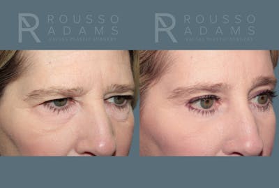 Blepharoplasty<span class=small>By Dr. Austin Adams</span> Before & After Gallery - Patient 364965 - Image 2