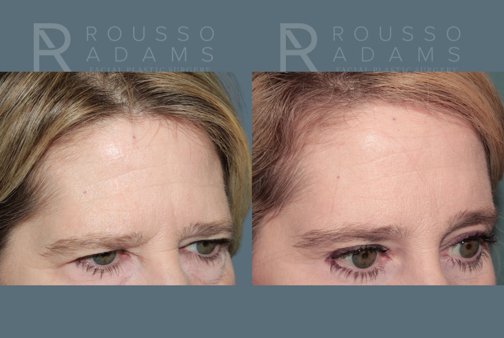 Blepharoplasty<span class=small>By Dr. Austin Adams</span> Before & After Gallery - Patient 364965 - Image 3