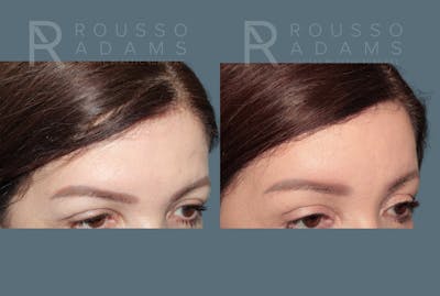 Deep Plane Facelift <span class=small>By Dr. Austin Adams</span> Before & After Gallery - Patient 192873 - Image 4