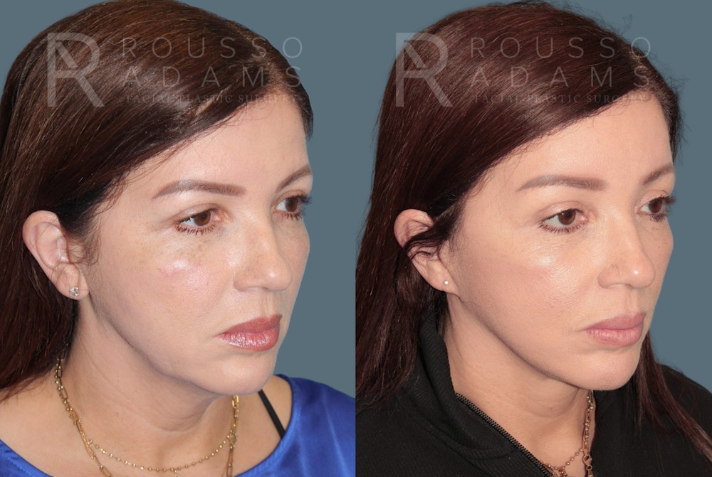 Deep Plane Facelift <span class=small>By Dr. Austin Adams</span> Before & After Gallery - Patient 192873 - Image 1