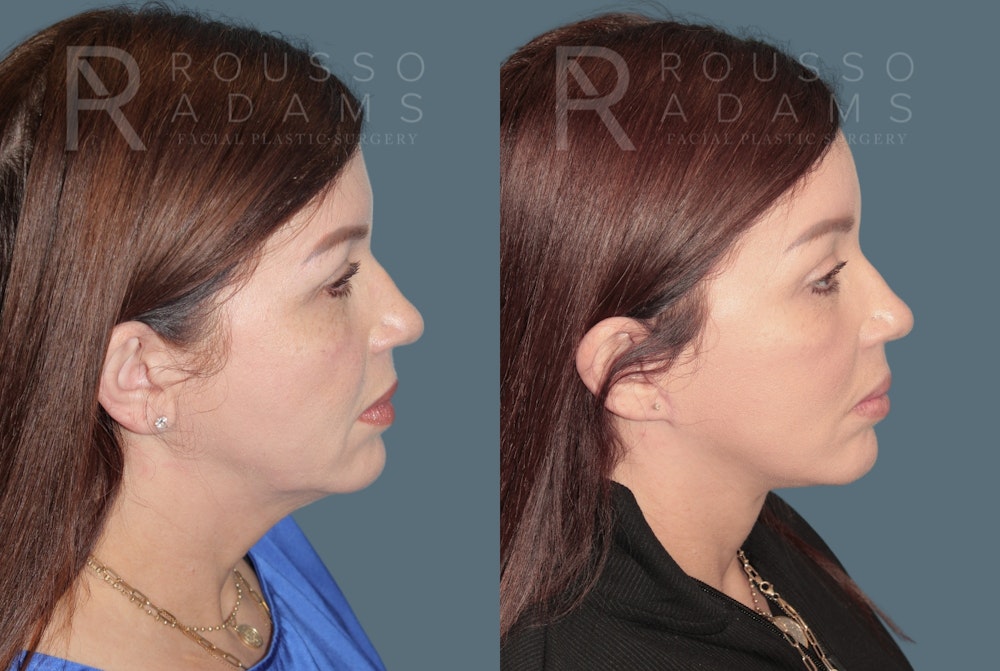 Deep Plane Facelift <span class=small>By Dr. Austin Adams</span> Before & After Gallery - Patient 192873 - Image 3