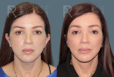 Deep Plane Facelift <span class=small>By Dr. Austin Adams</span> Before & After Gallery - Patient 192873 - Image 2