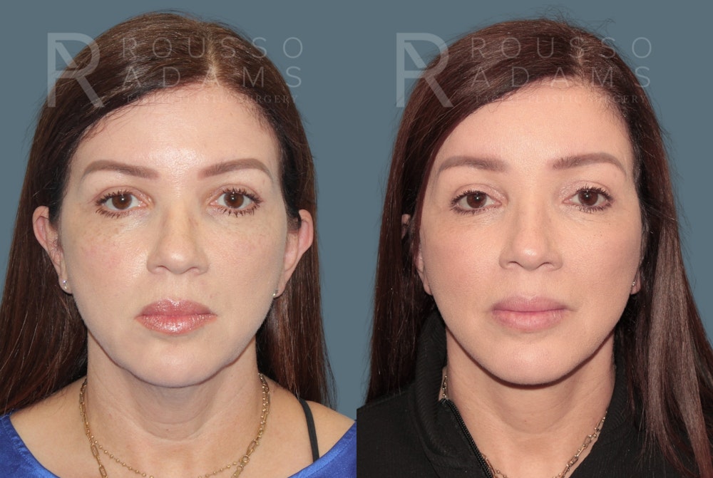 Deep Plane Facelift <span class=small>By Dr. Austin Adams</span> Before & After Gallery - Patient 192873 - Image 2