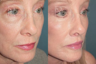 Deep Plane Facelift <span class=small>By Dr. Austin Adams</span> Before & After Gallery - Patient 149582 - Image 4
