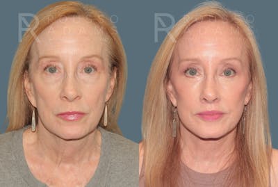 Deep Plane Facelift <span class=small>By Dr. Austin Adams</span> Before & After Gallery - Patient 149582 - Image 2
