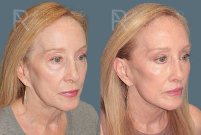 Deep Plane Facelift <span class=small>By Dr. Austin Adams</span> Before & After Gallery - Patient 149582 - Image 1
