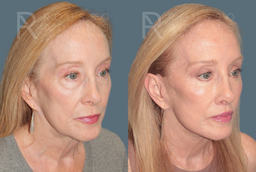 Deep Plane Facelift <span class=small>By Dr. Austin Adams</span> Before & After Gallery - Patient 149582 - Image 1