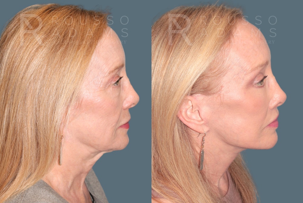 Deep Plane Facelift <span class=small>By Dr. Austin Adams</span> Before & After Gallery - Patient 149582 - Image 3