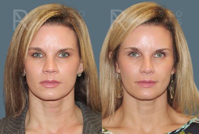 Rhinoplasty <span class=small>By Dr. Daniel Rousso</span> Before & After Gallery - Patient 802152 - Image 4