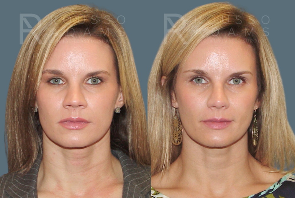 Rhinoplasty <span class=small>By Dr. Daniel Rousso</span> Before & After Gallery - Patient 802152 - Image 4