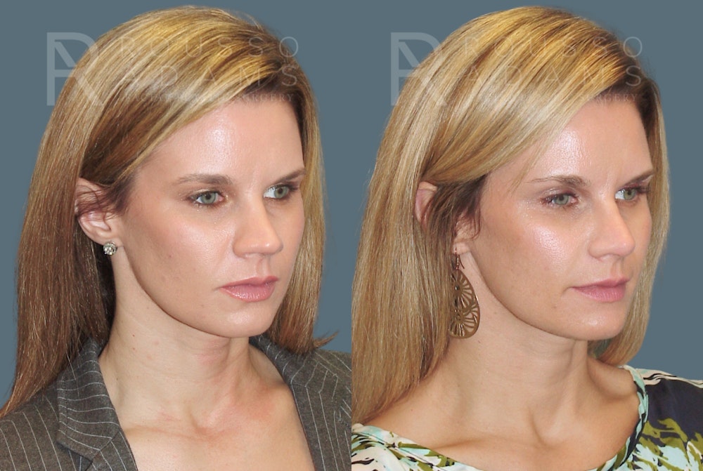 Rhinoplasty <span class=small>By Dr. Daniel Rousso</span> Before & After Gallery - Patient 802152 - Image 3