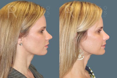 Rhinoplasty <span class=small>By Dr. Daniel Rousso</span> Before & After Gallery - Patient 802152 - Image 1
