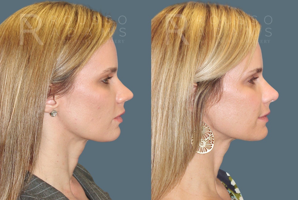 Rhinoplasty <span class=small>By Dr. Daniel Rousso</span> Before & After Gallery - Patient 802152 - Image 1