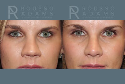Rhinoplasty <span class=small>By Dr. Daniel Rousso</span> Before & After Gallery - Patient 802152 - Image 2