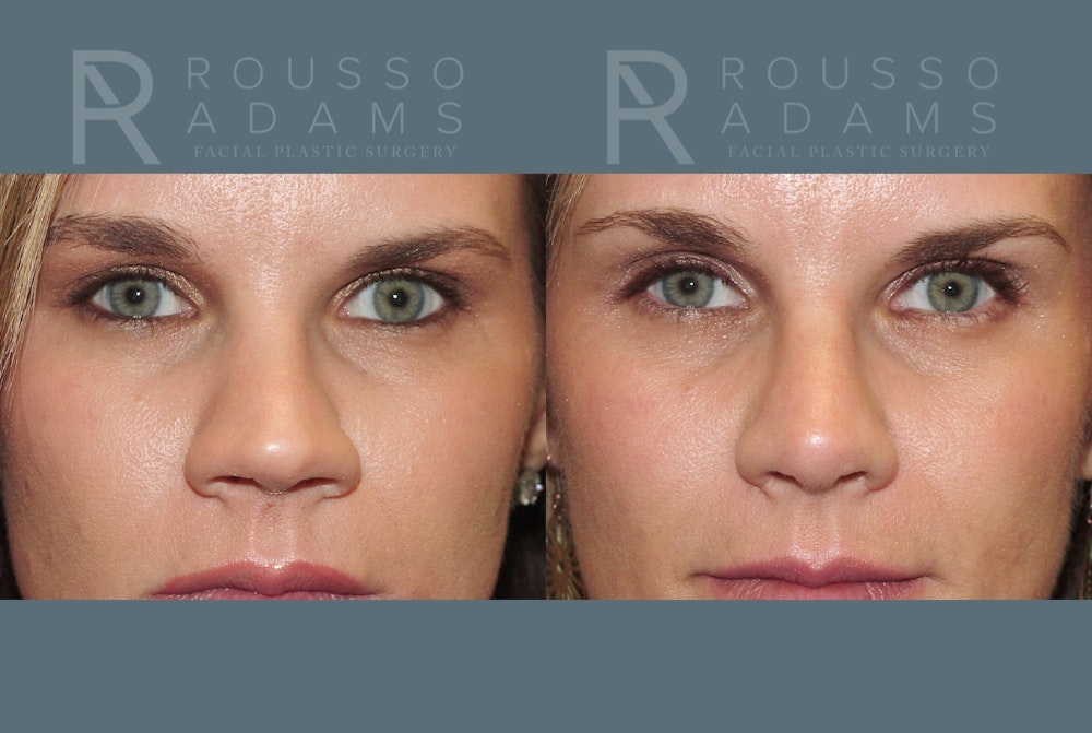 Rhinoplasty <span class=small>By Dr. Daniel Rousso</span> Before & After Gallery - Patient 802152 - Image 2
