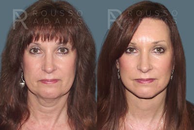 SculptLift™ <span class=small>By Dr. Daniel Rousso</span> Before & After Gallery - Patient 416096 - Image 2