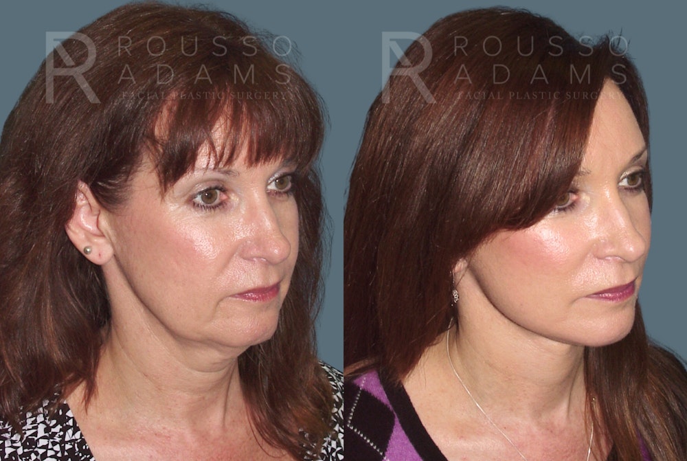 SculptLift™ <span class=small>By Dr. Daniel Rousso</span> Before & After Gallery - Patient 416096 - Image 1