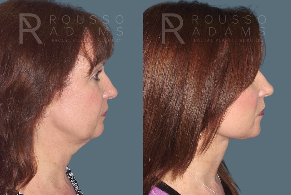 SculptLift™ <span class=small>By Dr. Daniel Rousso</span> Before & After Gallery - Patient 416096 - Image 3
