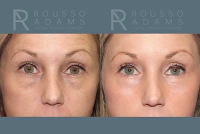 Blepharoplasty <span class=small>By Dr. Daniel Rousso</span> Before & After Gallery - Patient 295539 - Image 1