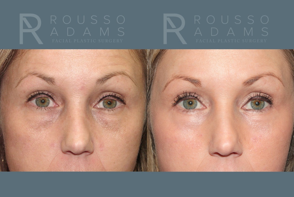 Blepharoplasty <span class=small>By Dr. Daniel Rousso</span> Before & After Gallery - Patient 295539 - Image 1