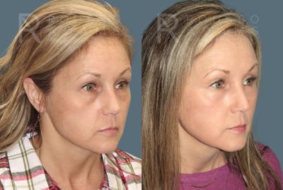 Blepharoplasty <span class=small>By Dr. Daniel Rousso</span> Before & After Gallery - Patient 295539 - Image 2