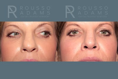 Rhinoplasty<span class=small>By Dr. Austin Adams</span> Before & After Gallery - Patient 141891 - Image 4