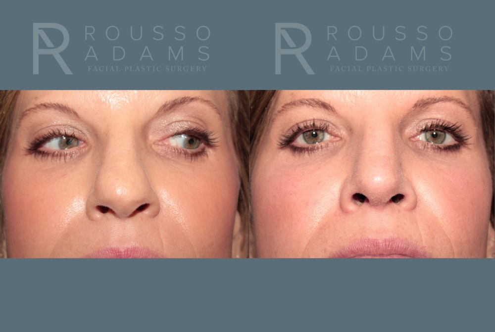 Rhinoplasty<span class=small>By Dr. Austin Adams</span> Before & After Gallery - Patient 141891 - Image 4