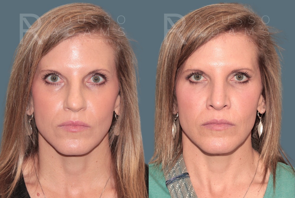 Rhinoplasty<span class=small>By Dr. Austin Adams</span> Before & After Gallery - Patient 141891 - Image 3