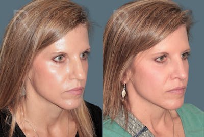 Rhinoplasty<span class=small>By Dr. Austin Adams</span> Before & After Gallery - Patient 141891 - Image 2