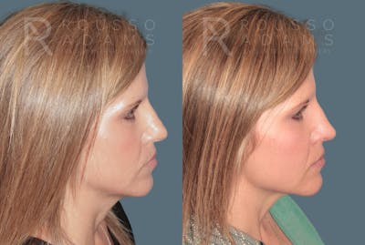Rhinoplasty<span class=small>By Dr. Austin Adams</span> Before & After Gallery - Patient 141891 - Image 1