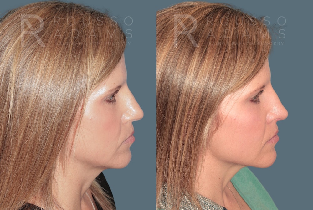 Rhinoplasty<span class=small>By Dr. Austin Adams</span> Before & After Gallery - Patient 141891 - Image 1
