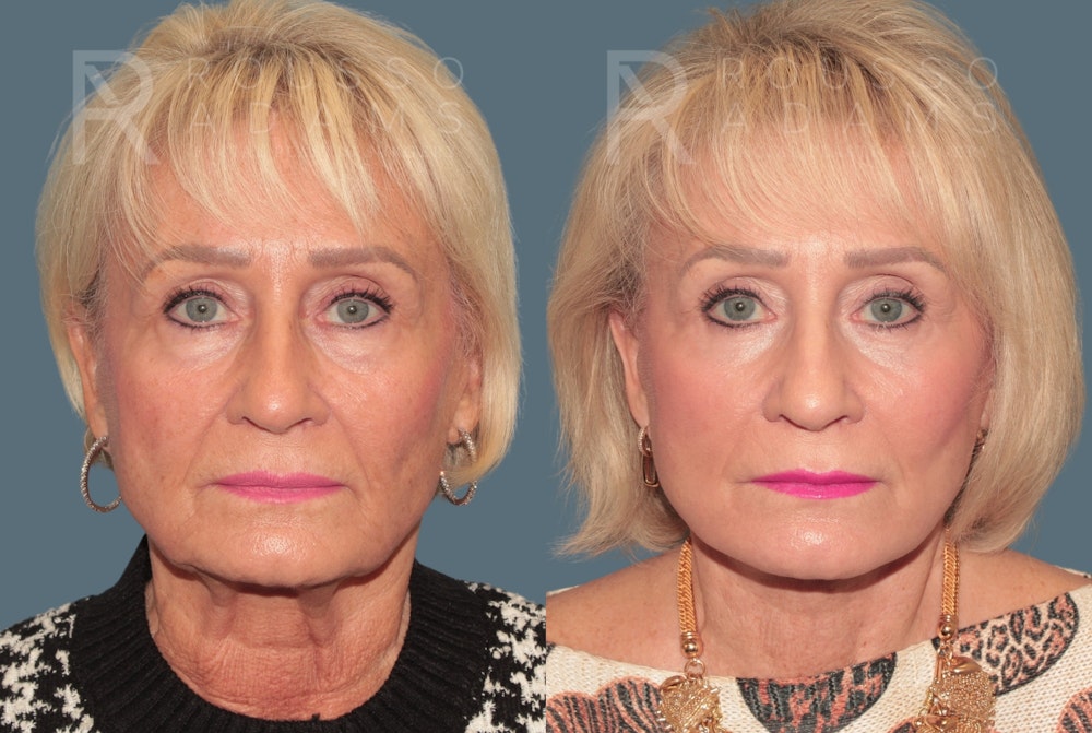 Deep Plane Facelift <span class=small>By Dr. Daniel Rousso</span> Before & After Gallery - Patient 327379 - Image 3
