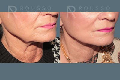 Deep Plane Facelift <span class=small>By Dr. Daniel Rousso</span> Before & After Gallery - Patient 327379 - Image 4