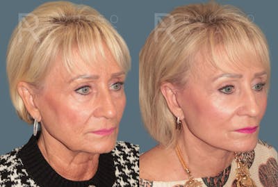 Deep Plane Facelift <span class=small>By Dr. Daniel Rousso</span> Before & After Gallery - Patient 327379 - Image 1