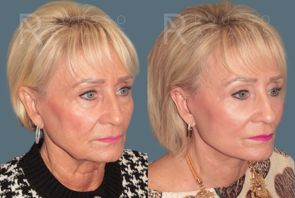 Deep Plane Facelift <span class=small>By Dr. Daniel Rousso</span> Before & After Gallery - Patient 327379 - Image 1