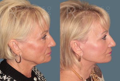 Deep Plane Facelift <span class=small>By Dr. Daniel Rousso</span> Before & After Gallery - Patient 327379 - Image 2