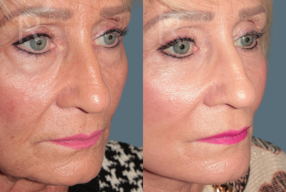 Deep Plane Facelift <span class=small>By Dr. Daniel Rousso</span> Before & After Gallery - Patient 327379 - Image 5