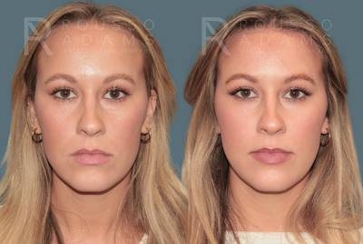 Brow Lift and Hairline Advancement<span class=small>By Dr. Austin Adams</span>  Before & After Gallery - Patient 403388 - Image 1