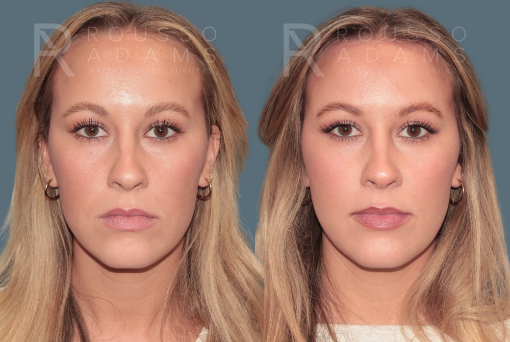 Brow and Hairline Advancement<span class=small>By Dr. Austin Adams</span> Before & After Gallery - Patient 126256 - Image 3