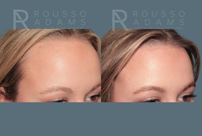 Brow and Hairline Advancement<span class=small>By Dr. Austin Adams</span> Before & After Gallery - Patient 126256 - Image 2